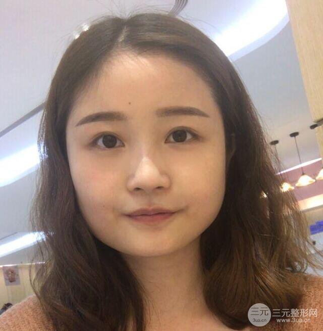 谁说脸大没未来，下颌角整形后我轻松美出新高度