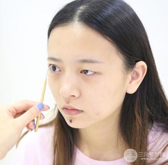 扬州艾菲斯黄婵眼综合整形效果真人反馈