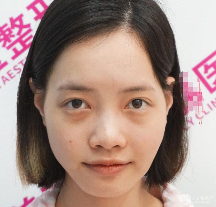 上海华美李健自体脂肪全面部填充效果图，少女脸经久不衰的秘密在这里