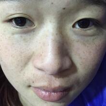 在南京光尔美医疗美容医院做的激光祛斑治疗分享