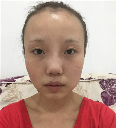 v－line瓜子脸整形手术前后照片分享，丹东市第