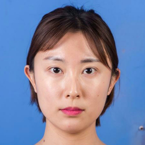 这个月刚做了驼峰鼻矫正整形手术，分享术前术后的照片~