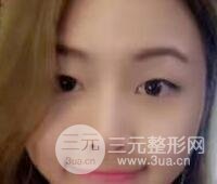 开内眼角和韩式三点双眼皮恢复过程图片真人案例分享