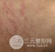 果酸换肤去妊娠纹真人案例和妊娠纹整形手术前后对比图