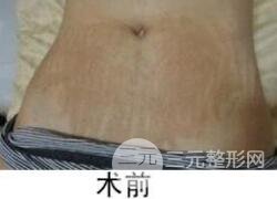 如何去除妊娠纹？做了果酸换肤去妊娠纹效果不