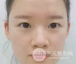 韩式三点双眼皮整形恢复图案例