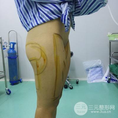 武汉美仑陈远海医生做的大腿吸脂案例，分享一