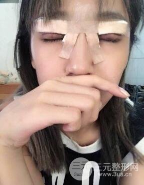 南京康美陈小剑做的双眼皮案例效果真实的分享给你们！