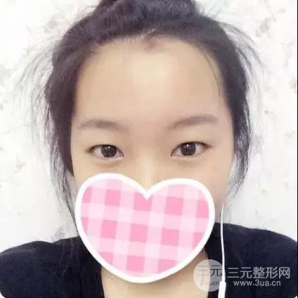 上海华美杨亚益双眼皮案例恢复效果日记