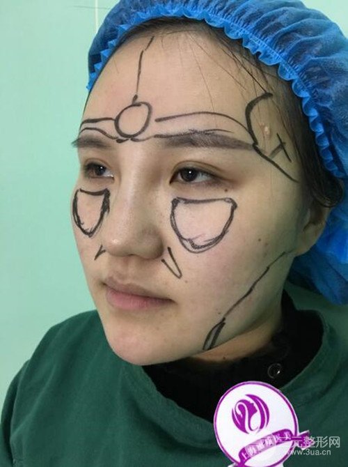 上海丽质吕成医生做的吸脂瘦脸日记，前后恢复