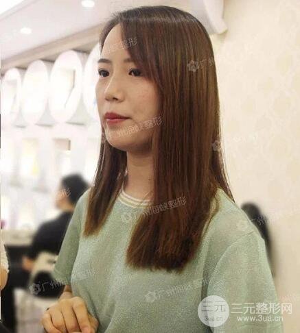 广州海峡李希军隆鼻失败修复案例术后记录