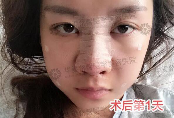 华美紫馨邱伟做的隆鼻术后10天惊人效果分享！