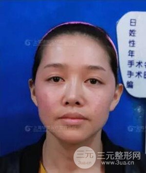 隆鼻失败修复+全面部自体脂肪填充案例分享，上海华美做的!