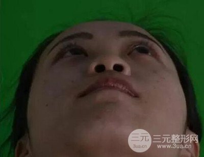 长沙鹏爱彭正春假体隆鼻案例分享