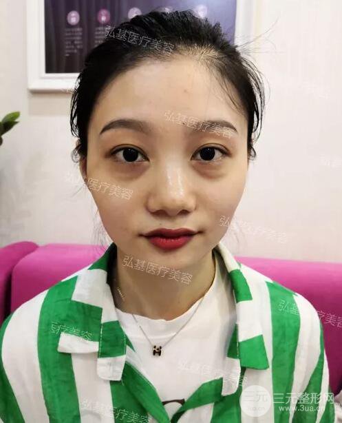 广州弘基医疗美容祛眼袋案例,看看她是怎么变美的！