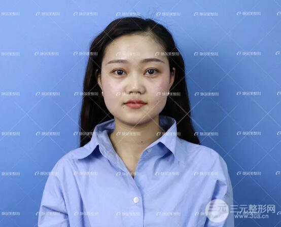 南京施尔美整形孙欣线D案例,重返17岁！