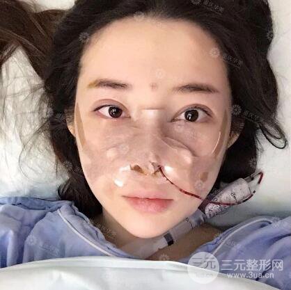 重庆华美何春涛假体隆鼻案例过程恢复分享