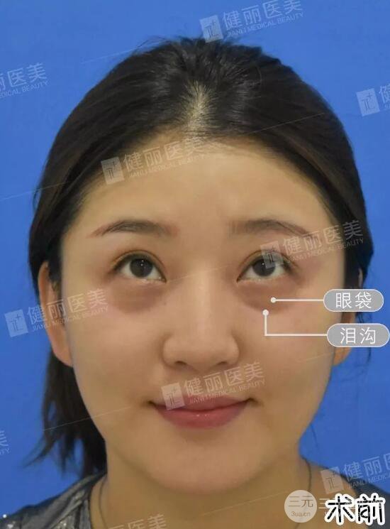 深圳健丽微创去眼袋+眶隔脂肪转移术前后对比效果图分享！