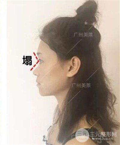 广州美莱自体软骨隆鼻案例前后对比图分享!