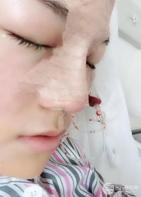 杭州华山连天美高俊明假体隆鼻术前术后对比图 两个月恢复心情