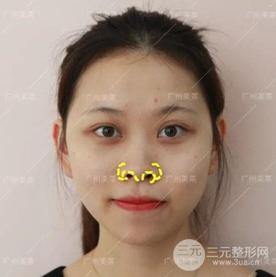 广州美莱鼻综合+自体脂肪填充面部前后对比图以