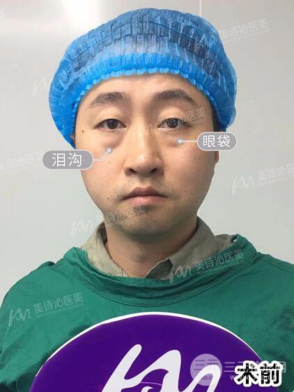 北京诗美沁祛眼袋案例，男士无痕祛眼袋效果分享！