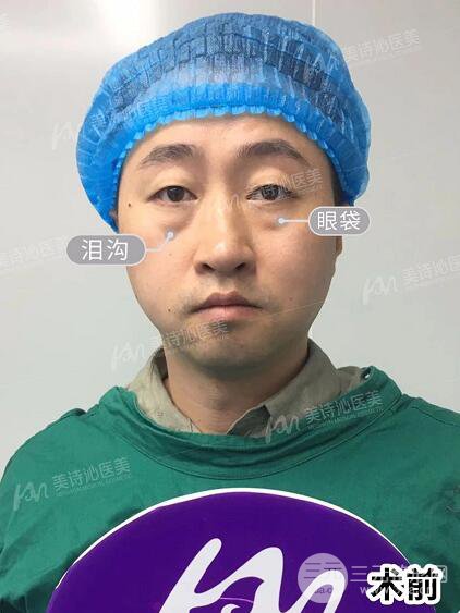 北京诗美沁祛眼袋案例,男士无痕祛眼袋效果分