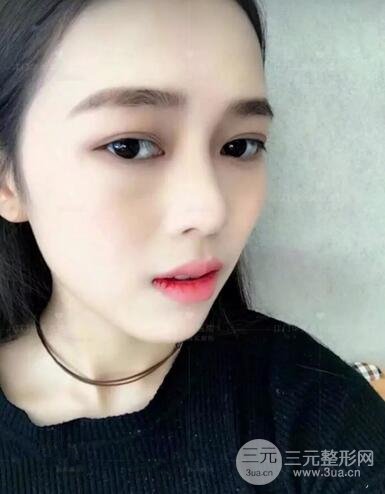 重庆爱思特整形隆鼻案例术后恢复效果分享!