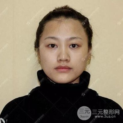 沈阳百嘉丽汪晓蕾自体脂肪面部填充恢复记录案