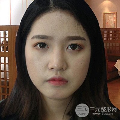 肖凌做的鼻综合,分享恢复过程图~