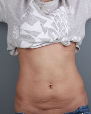 腰腹吸脂整形对比图 肚子小了很多