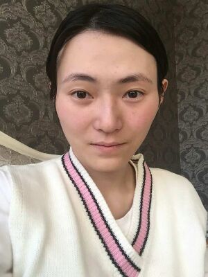 太原美莱全脸脂肪填充+自体脂肪丰胸恢复效果图