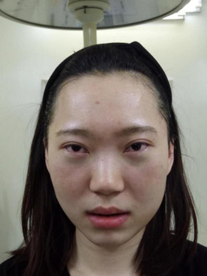 内切祛眼袋手术真实案例，武汉天申胡丽医生做的