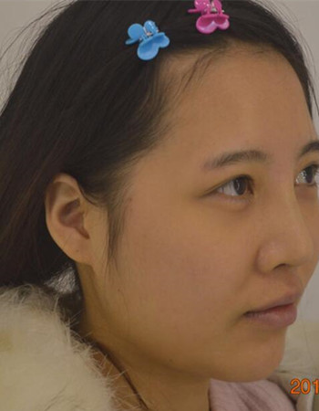 北京吸脂瘦脸真人案例恢复过程分享，巴掌小脸