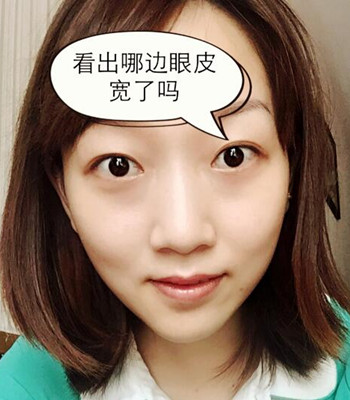 北京双眼皮失败修复手术日记分享，附上前后对