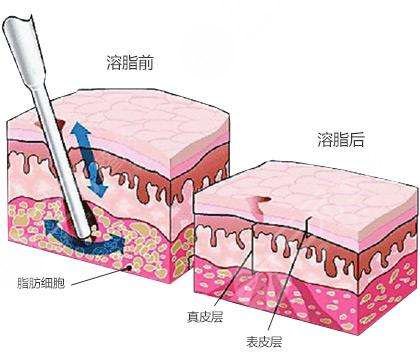 腹部抽脂减肥一般多少钱