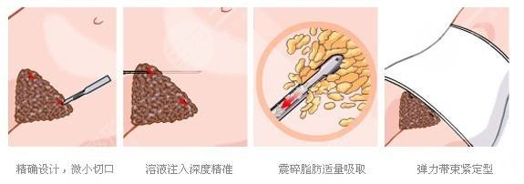 腹部抽脂减肥安全吗