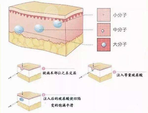 打玻尿酸垫下巴