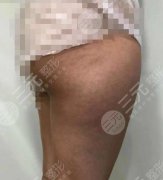 大腿环吸记录过程分享，我的美腿日记给姐妹们参考！