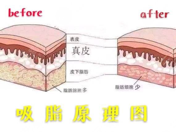 背部吸脂手术多少钱