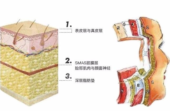 埋线面部提升